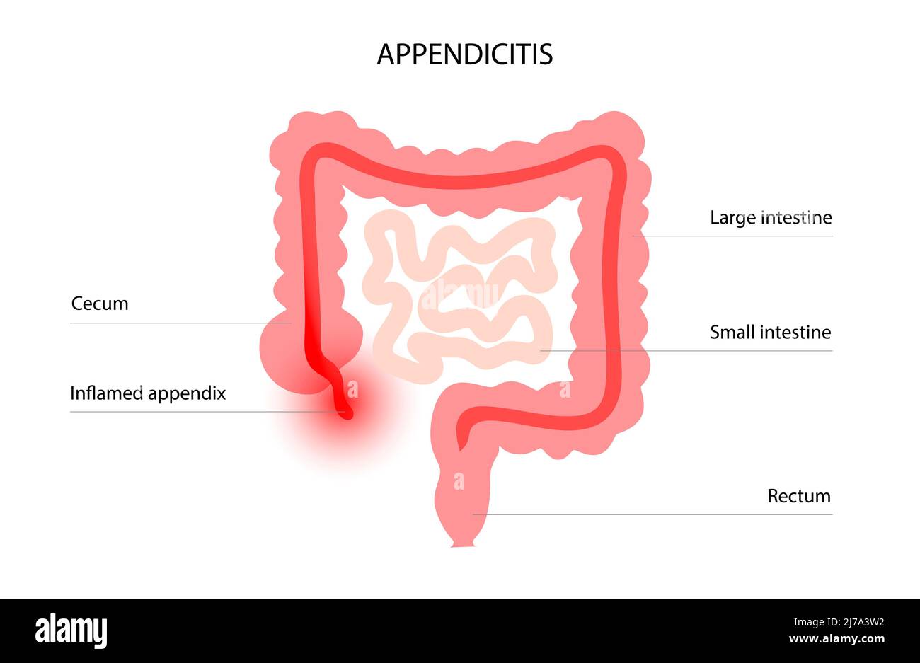 Inflamed appendix, conceptual illustration Stock Photo - Alamy