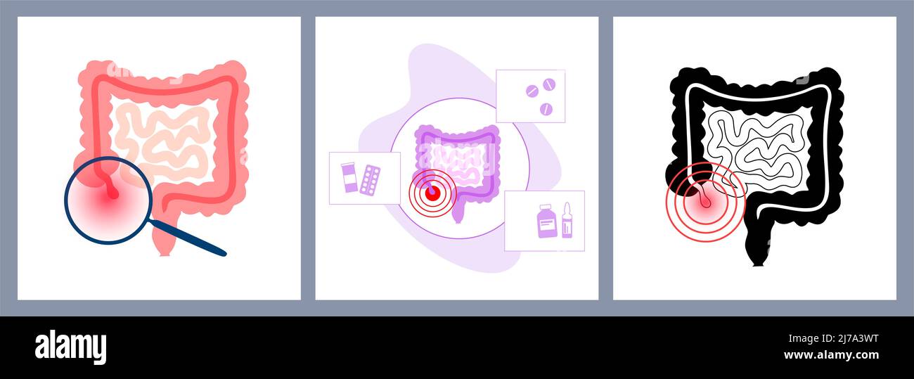 Inflamed appendix, conceptual illustration Stock Photo - Alamy