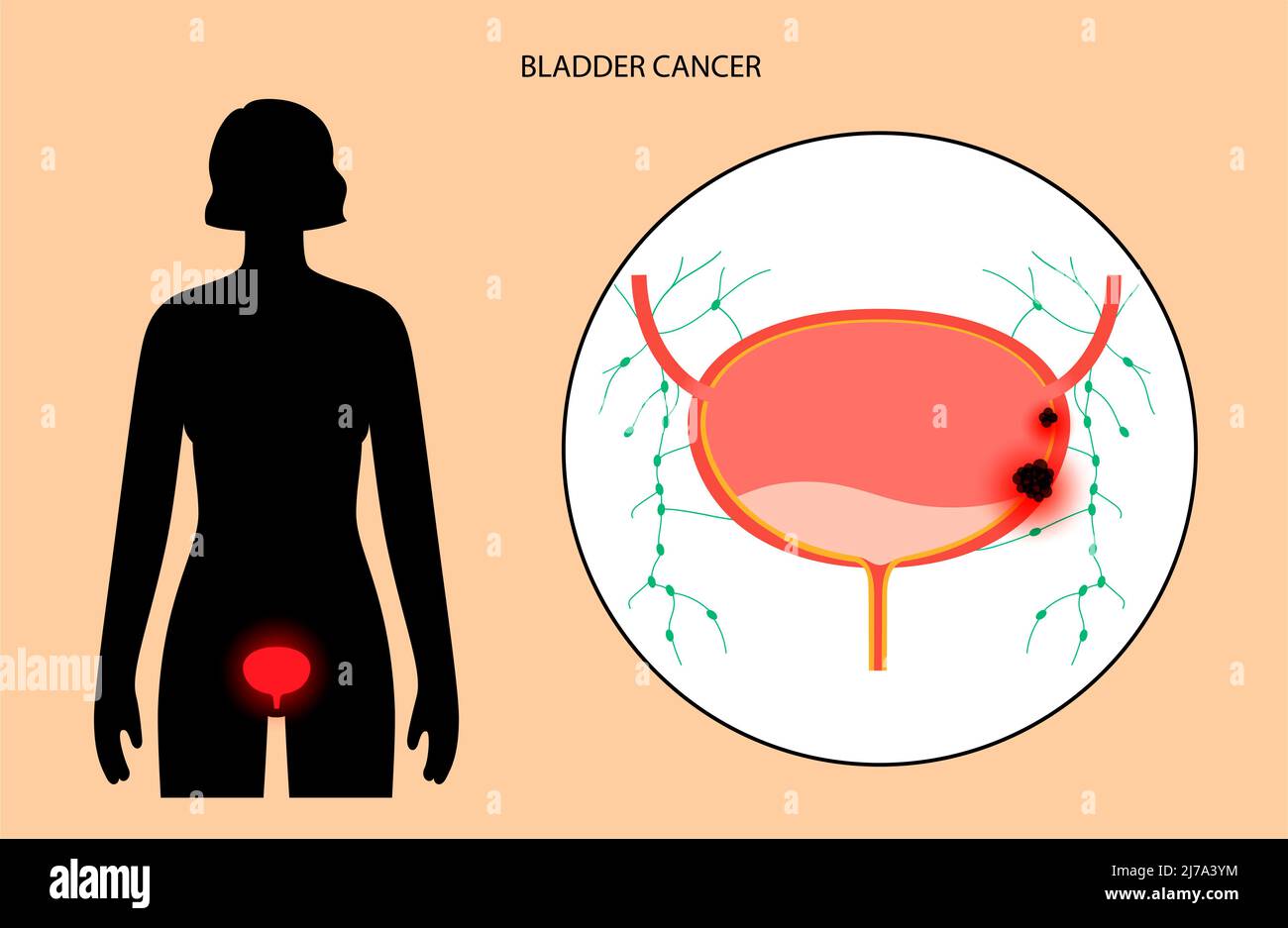 Bladder cancer stages, illustration Stock Photo