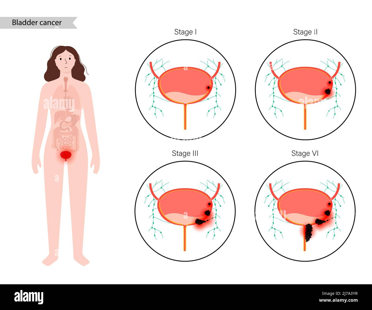 Bladder cancer stages, illustration Stock Photo