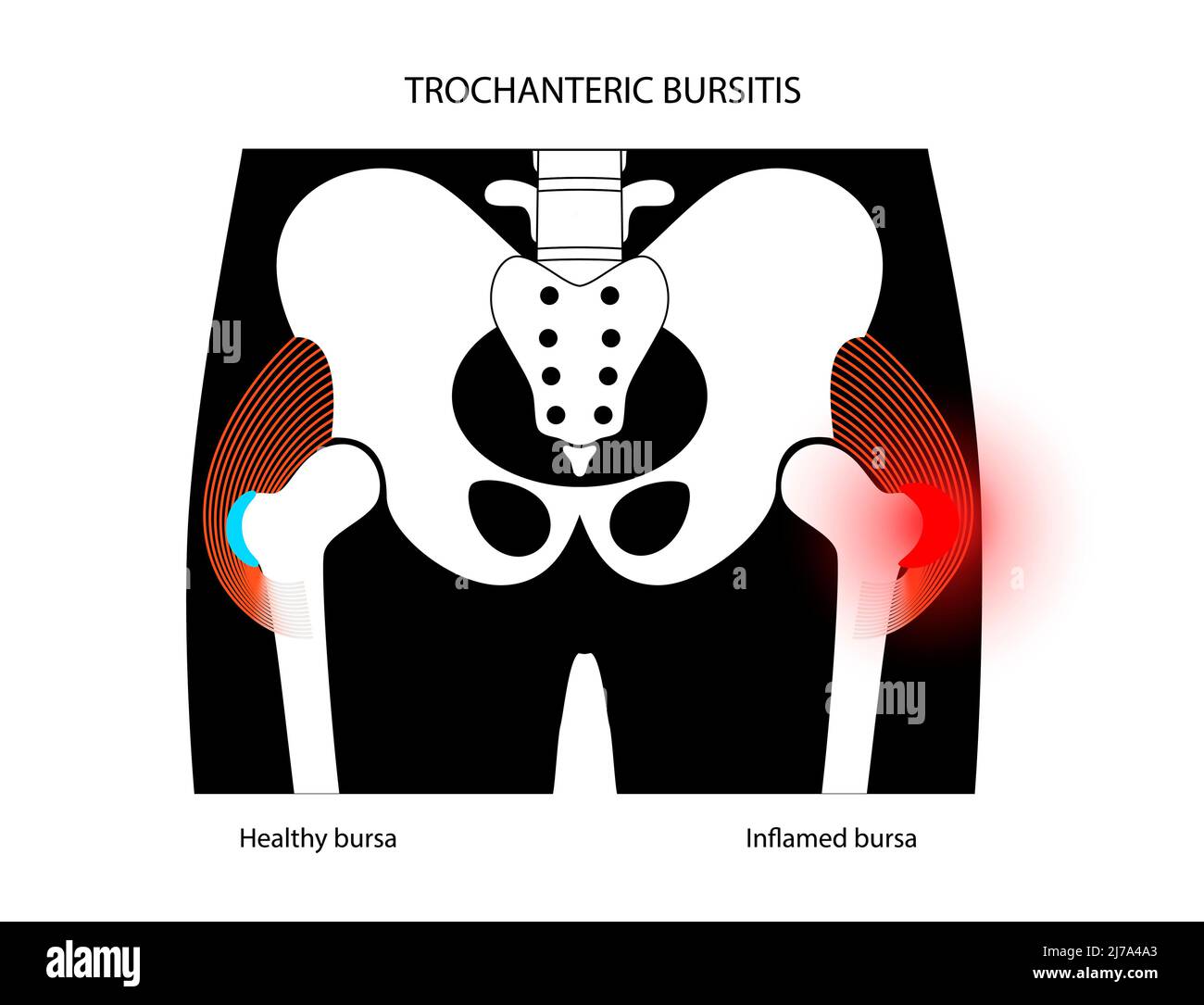 Hip bursitis, conceptual illustration Stock Photo