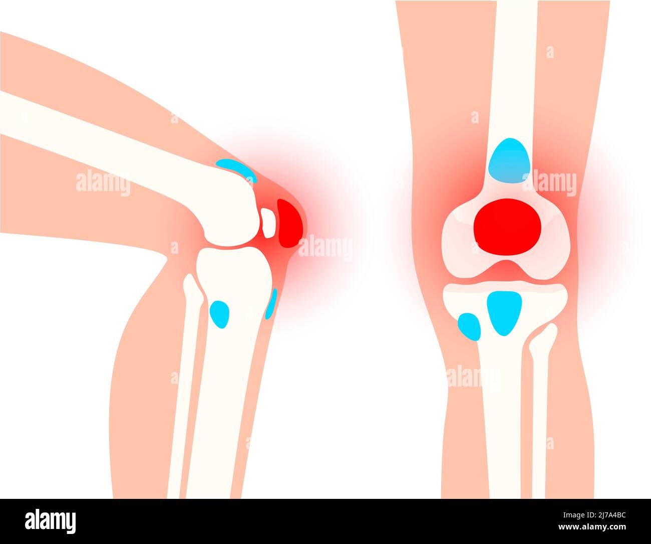 Knee bursitis, conceptual illustration Stock Photo