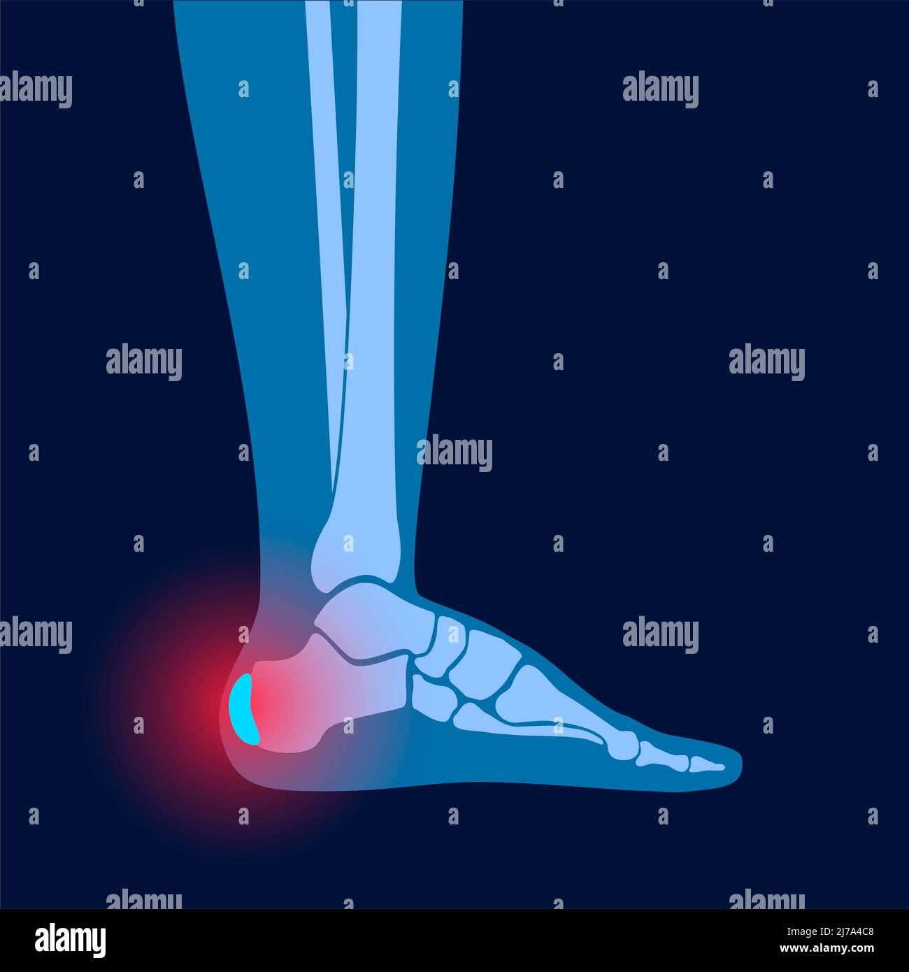 Heel bursitis, conceptual illustration Stock Photo
