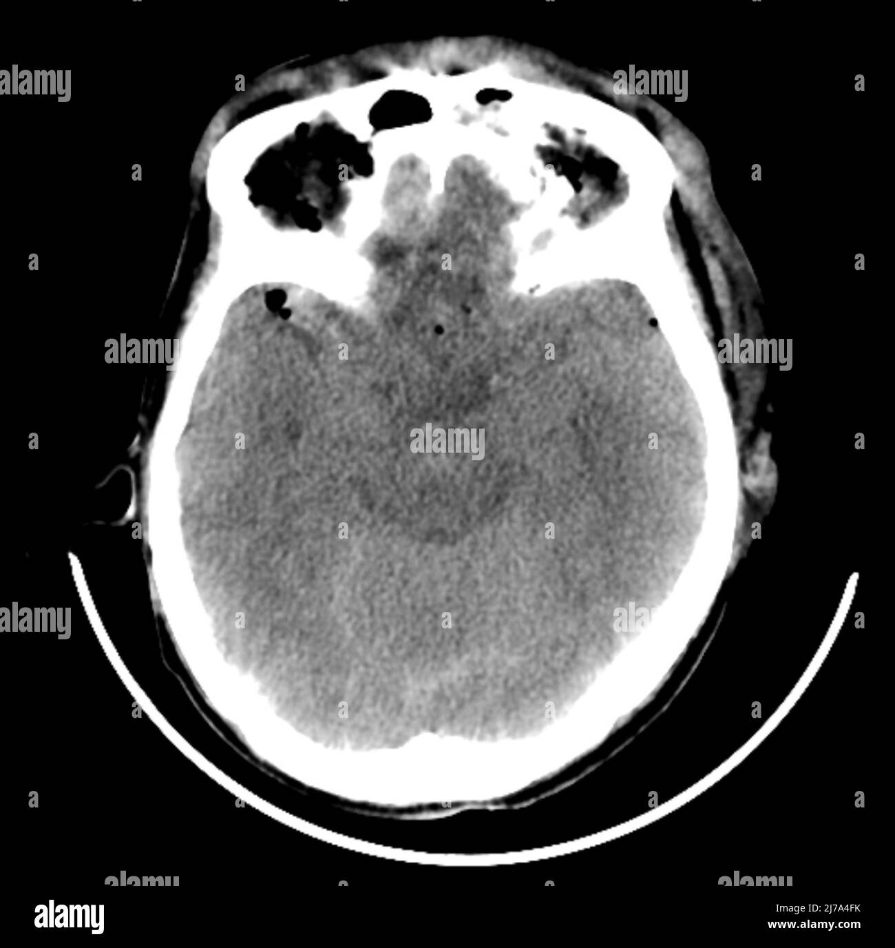 Traumatic brain injuries, CT scan Stock Photo