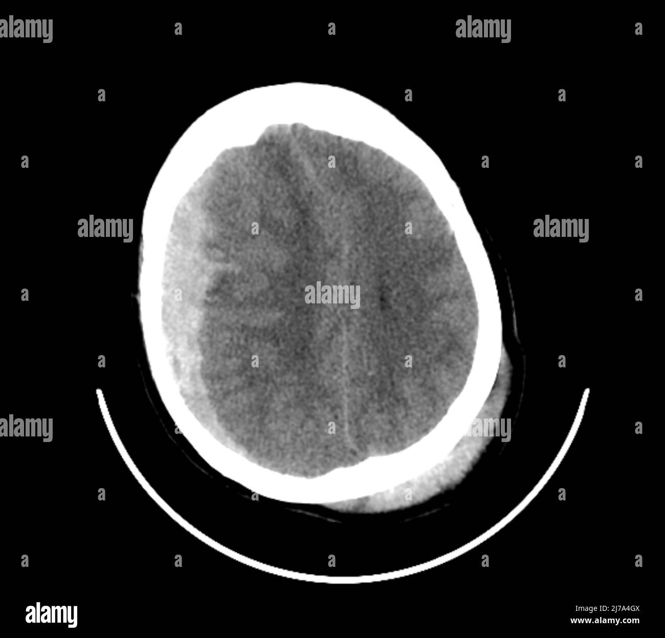 Traumatic brain injuries, CT scan Stock Photo