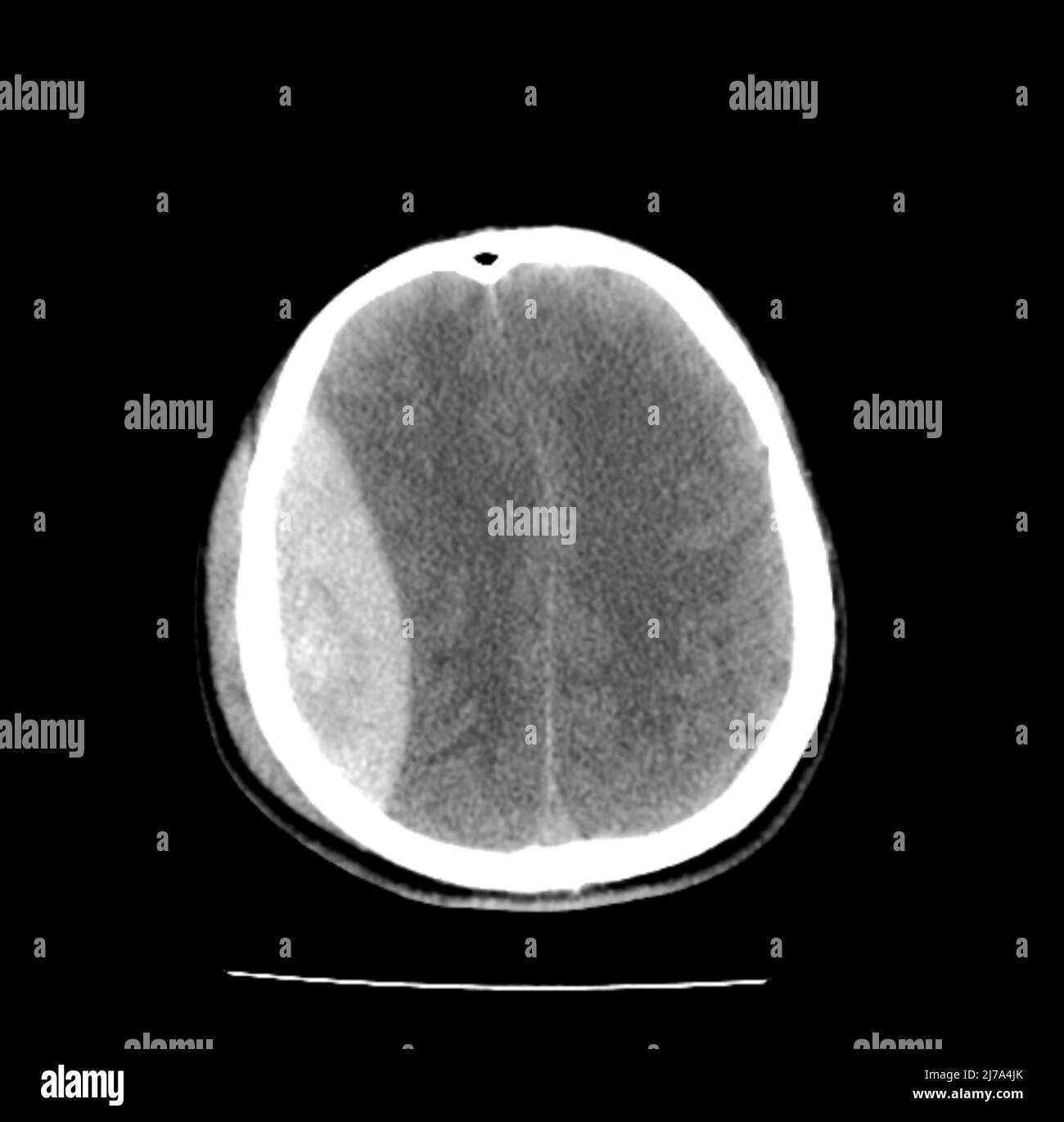 Concussion brain scan Black and White Stock Photos & Images Alamy