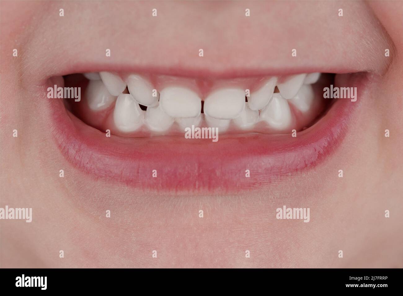 Closeup of healthy milk teeth Stock Photo Alamy