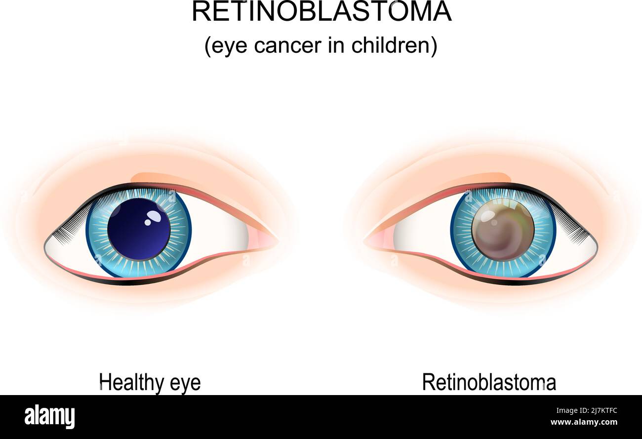 Retinoblastoma. eye cancer in children. comparison of Healthy eye and leukocoria. eye with hereditary genetic defect. Vector illustration Stock Vector