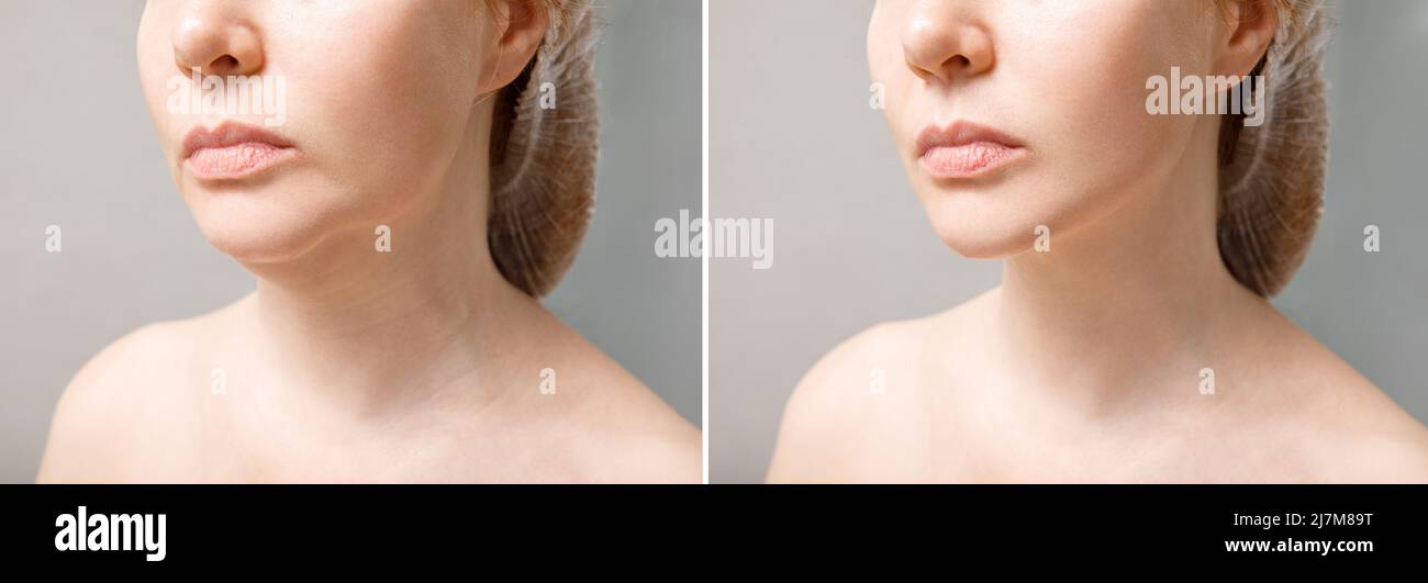 Female double chin before and after correction. Correction of the chin shape liposuction of the neck. The result of the procedure in the clinic of Stock Photo
