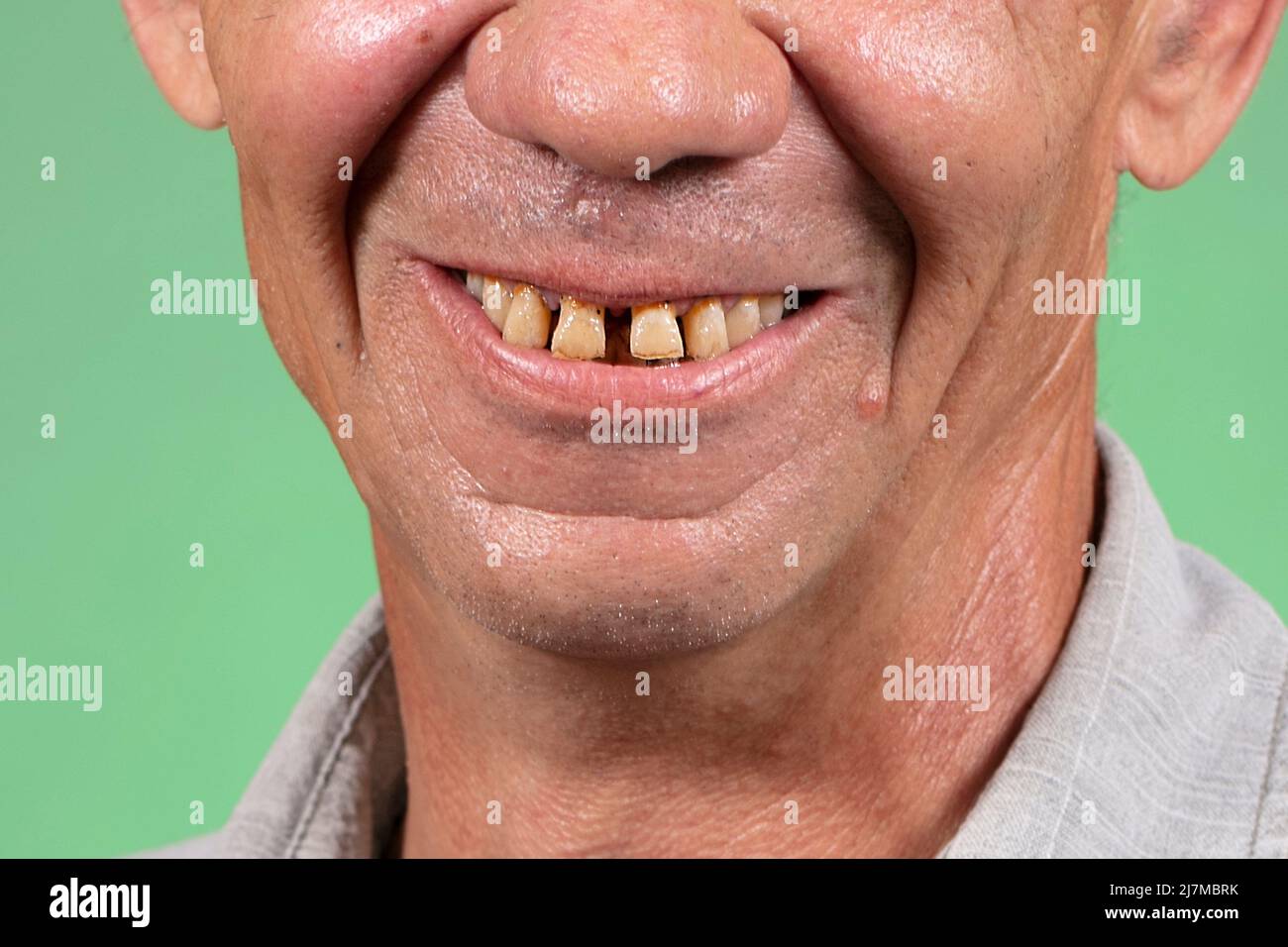 Part of the face with ugly yellow and sparse teeth. Dental problems of anterior teeth in an elderly person.Smiling mouth of a man with crooked yellow Stock Photo