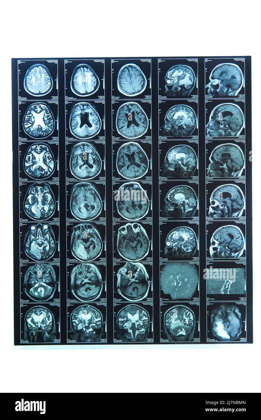 A snapshot of an elderly person's brain scan on magnetic resonance imaging MRI film, for neurological medical diagnosis of brain diseases. Stock Photo