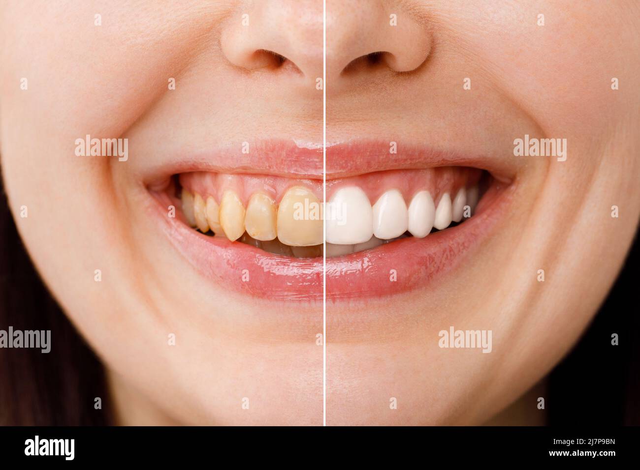 woman teeth before and after whitening. Over white background. Dental clinic patient. Image symbolizes oral care dentistry, stomatology. Stock Photo
