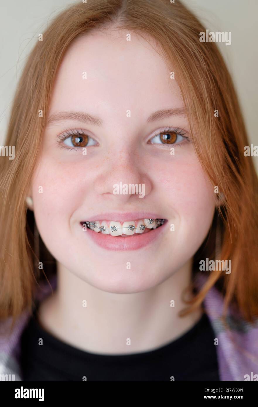 beautiful caucasian young girl in dental braces smiles. Teenage concept