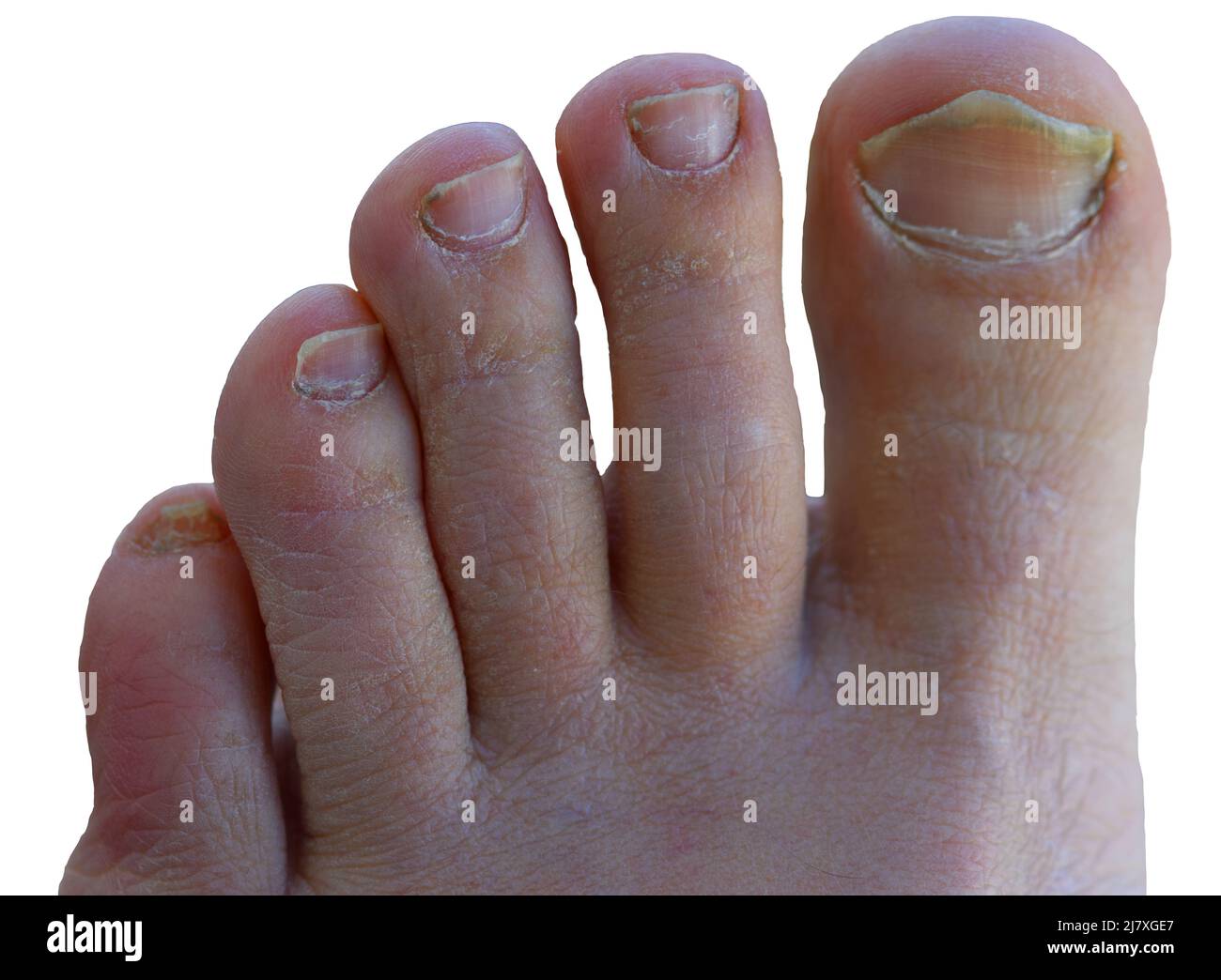 Macro shot of a male foot with yellow ugly fungus on toenails isolated on a white background. Fungal nail infection. Advanced stage of disease. Top vi Stock Photo