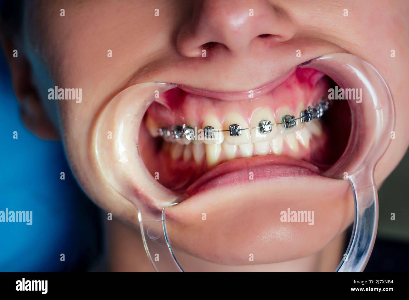female dental open mouth with fixator gel braces at the reception