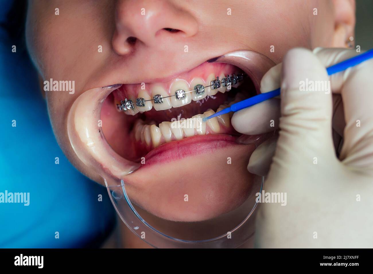 female dental open mouth with fixator gel braces at the reception.Bracket  System kappa close up Stock Photo - Alamy
