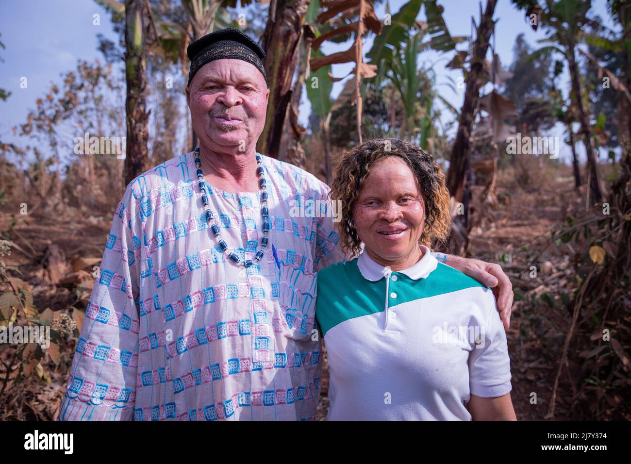 Portrait of an African father and daughter suffering from albinism, people with little melanin in their skin Stock Photo