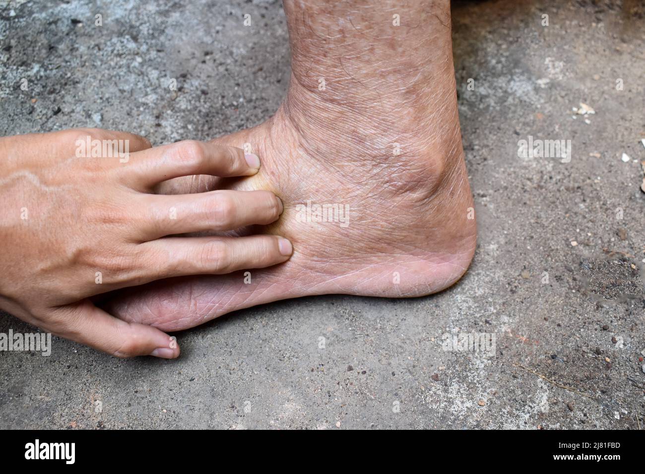 Pitting edema of lower limb. Swollen leg of Asian old man. Stock Photo