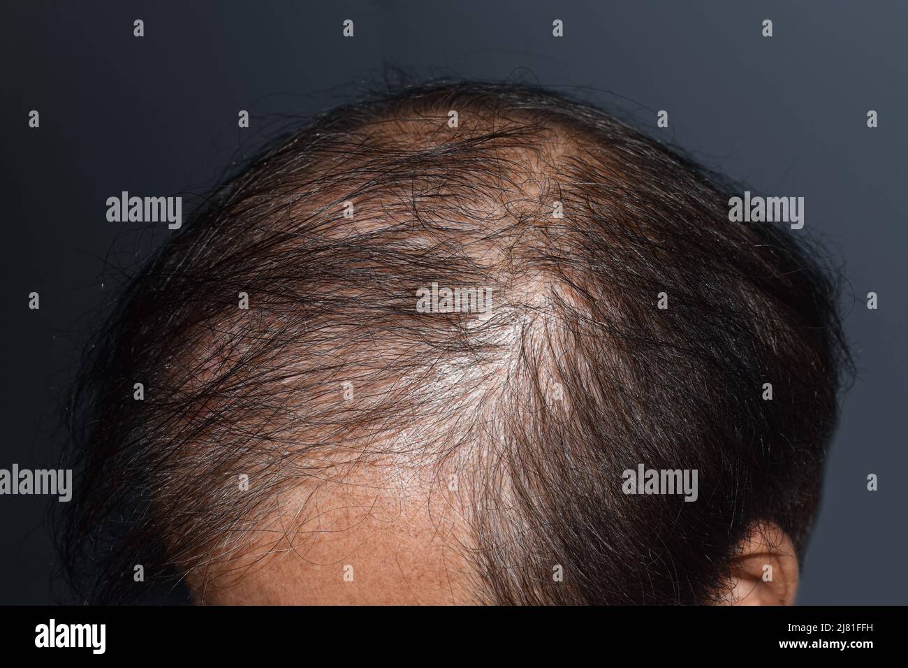 Thinning or sparse hair, male pattern hair loss in Southeast Asian, Chinese elder man. Stock Photo