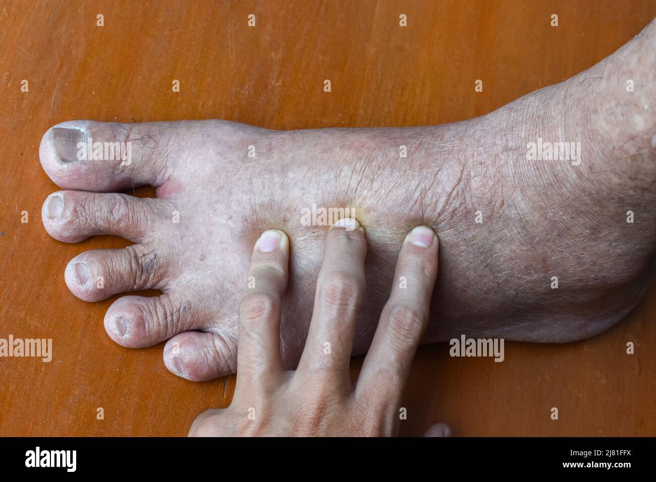 Pitting edema of lower limb. Swollen leg of Asian old man. Stock Photo
