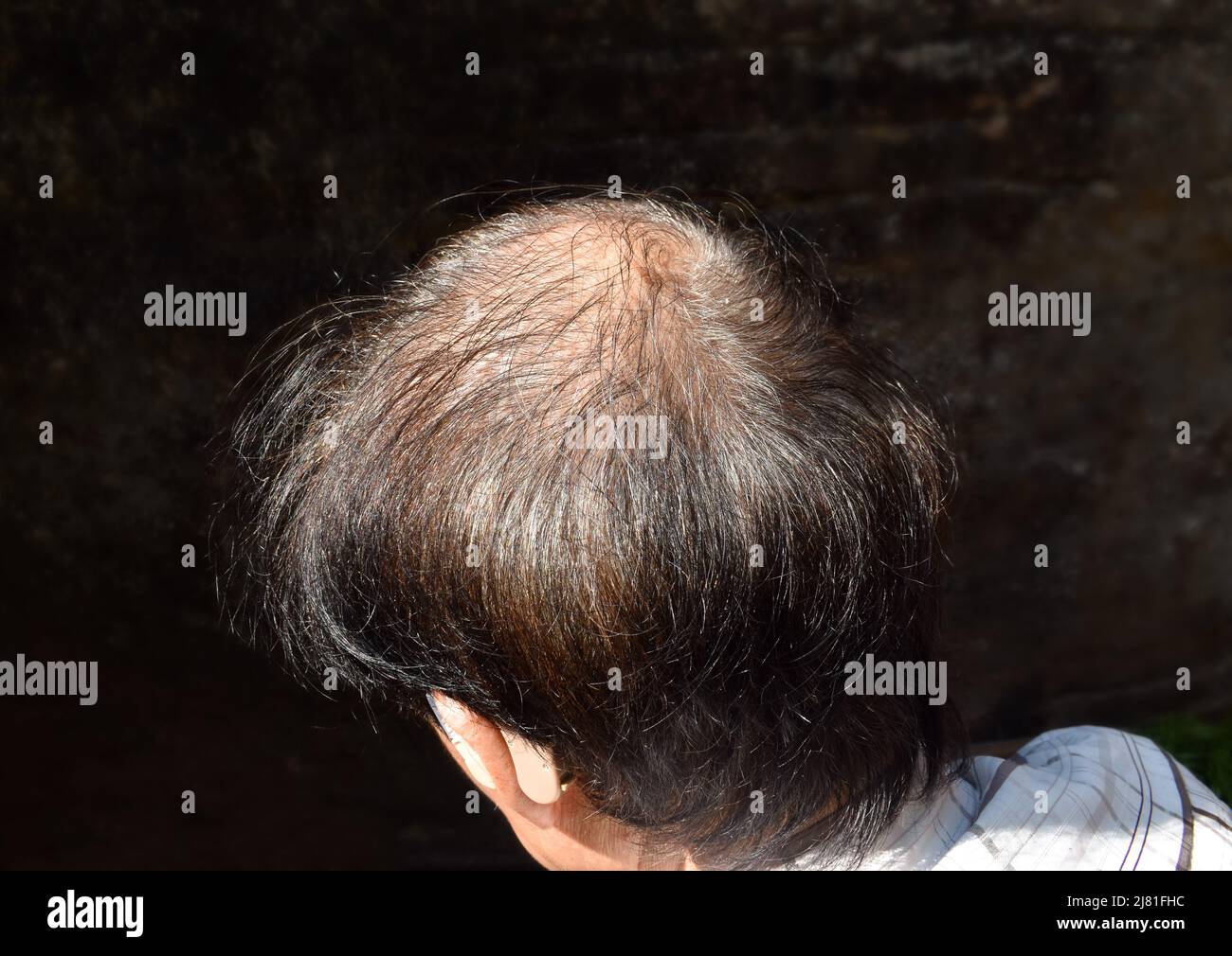 Thinning or sparse hair, male pattern hair loss in Southeast Asian, Chinese elder man. Stock Photo
