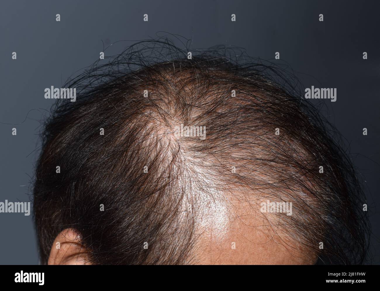 Thinning or sparse hair, male pattern hair loss in Southeast Asian, Chinese elder man. Stock Photo
