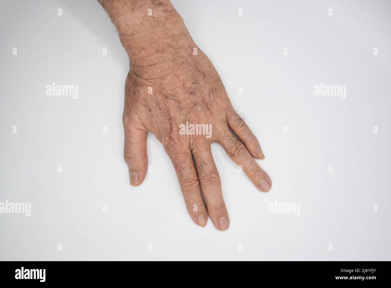 Spastic hand. Hand muscle spasticity. Concept of hand health. Stock Photo