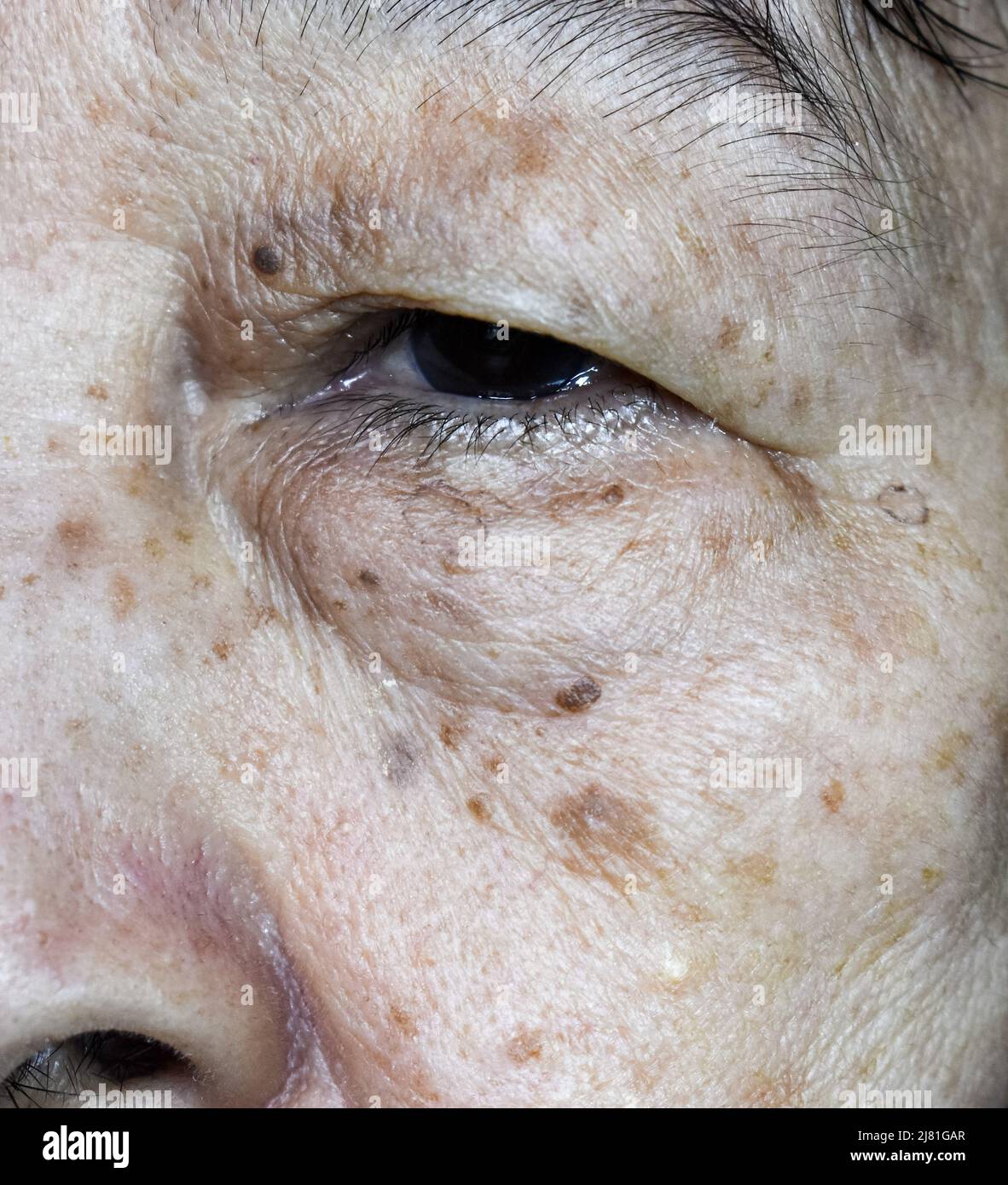 Liver spots on face hires stock photography and images Alamy