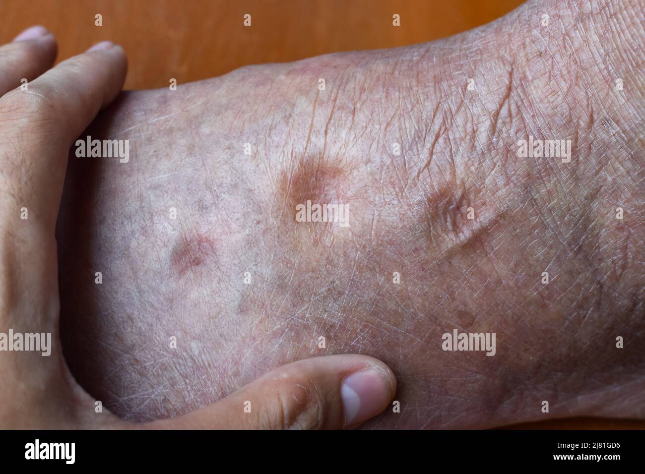 Lower Extremity Pitting Edema