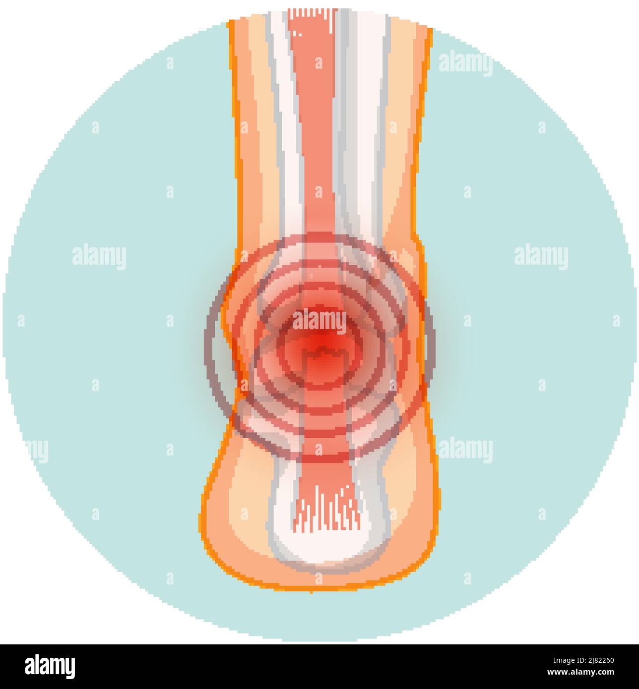 Ta Rupture Achilles tendo rupture in circle template illustration Stock Vector ...