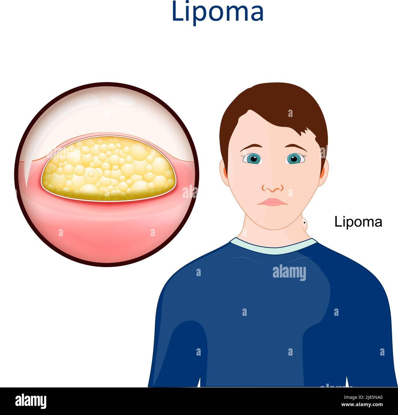 Lipoma. Skin disease. Close-up of a growth of fat tissue under human skin. Vector illustration Stock Vector