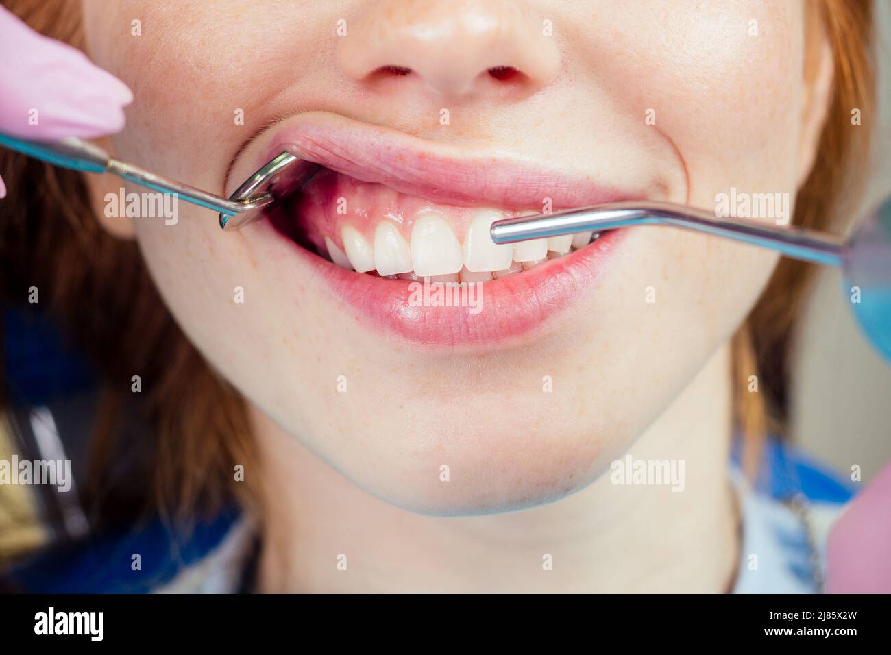 Dental drilling procedure and check up on beautiful teeth and open