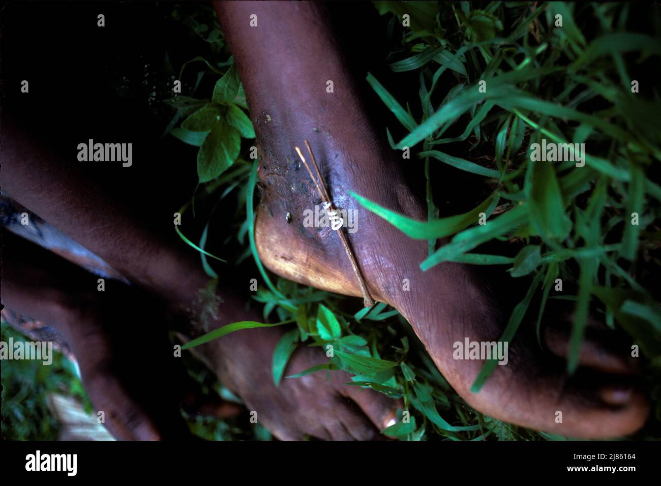Extraction of a Guinea Worm Benin Stock Photo