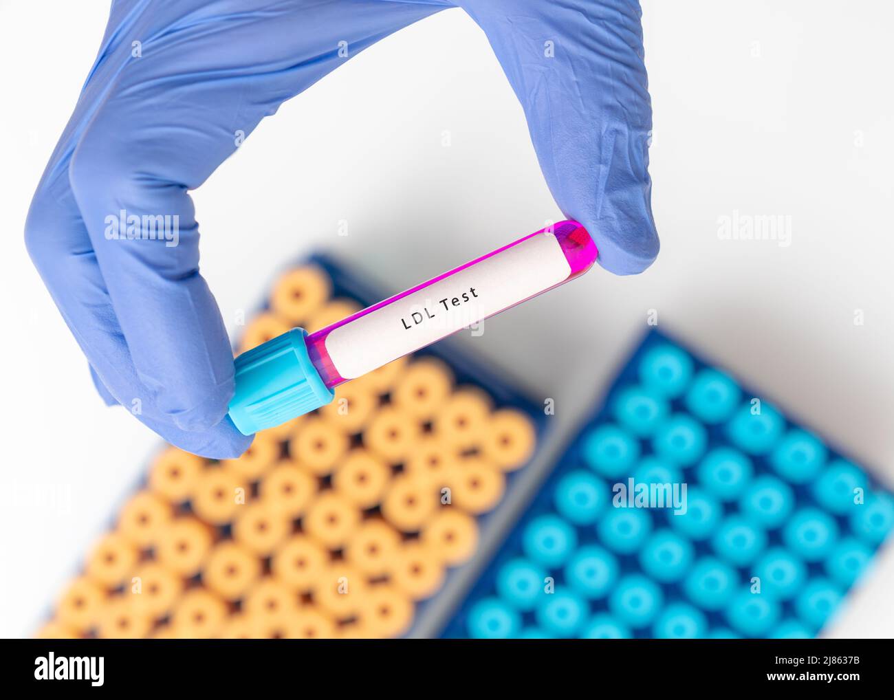 Biochemistry Blood sample for LDL  low-density lipoprotein test Stock Photo