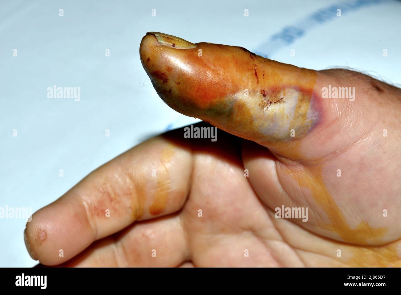Finger 2 days after a bite of Indian Cobra Stock Photo