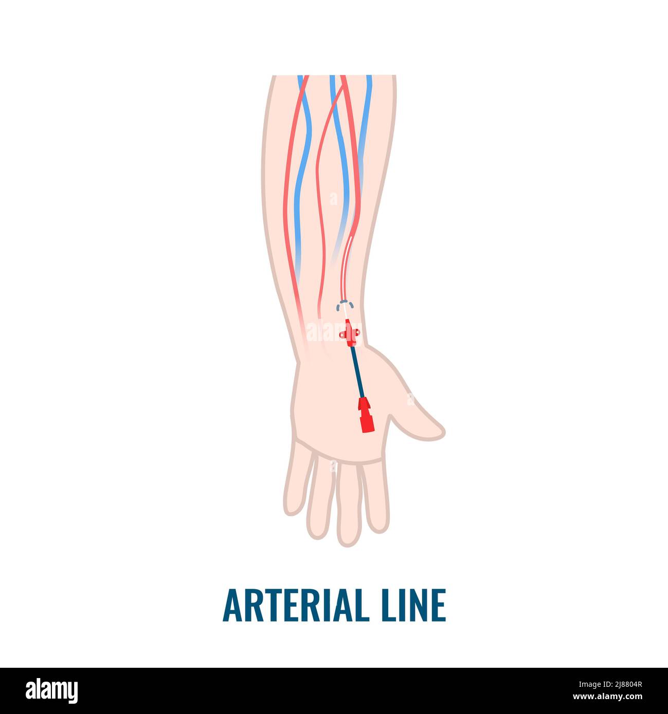 Arterial line hi-res stock photography and images - Alamy
