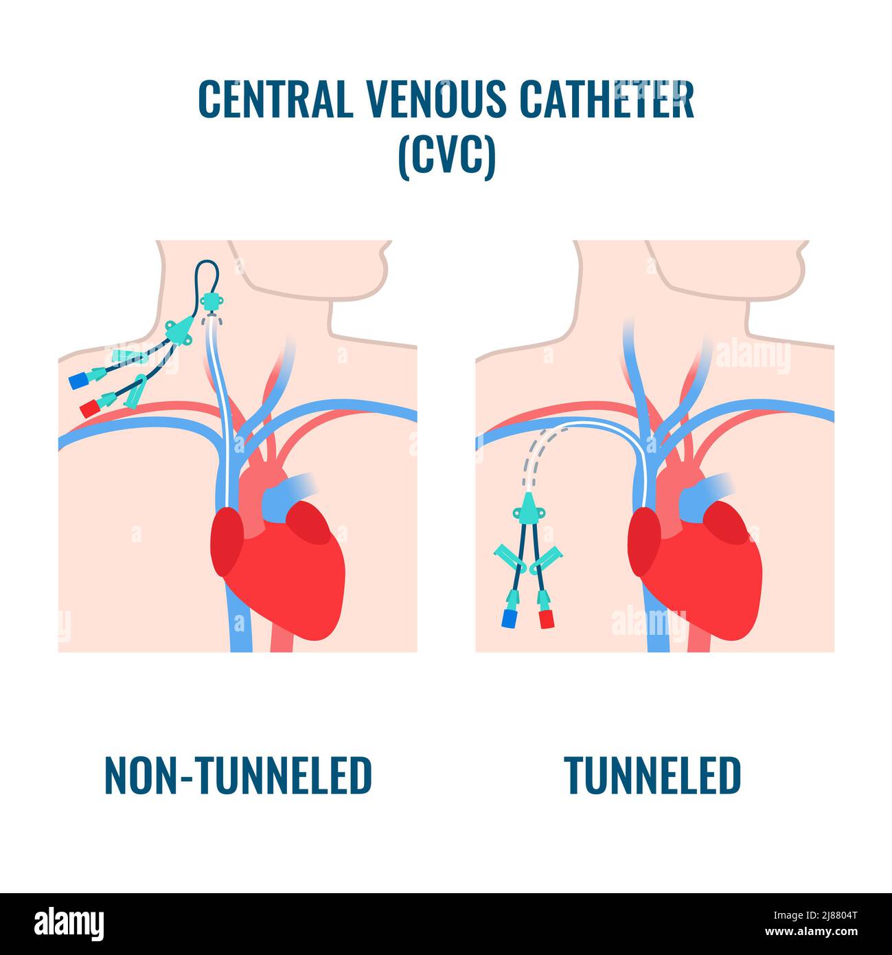 Central venous catheter, illustration Stock Photo Alamy