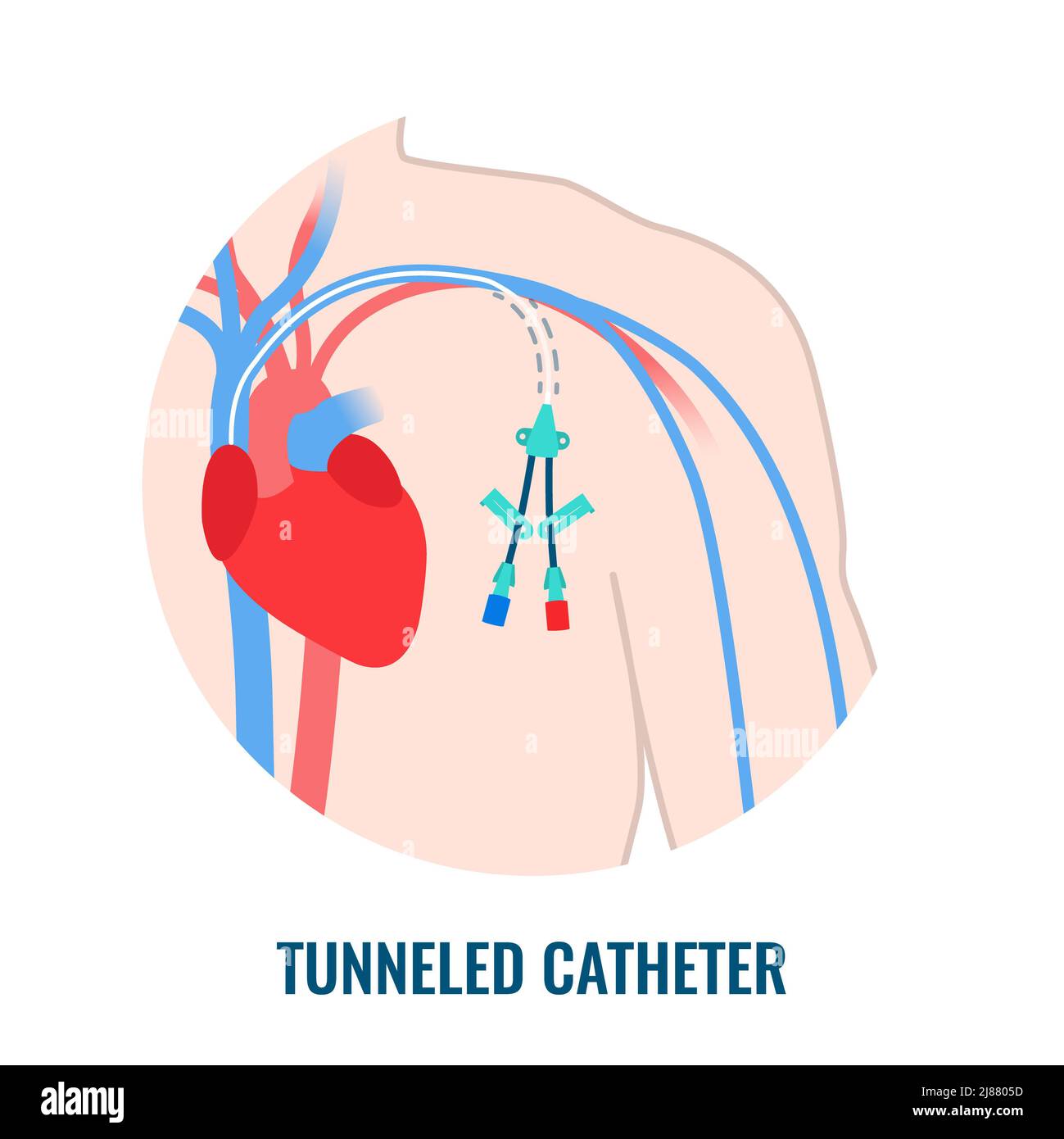 Central venous catheter, illustration Stock Photo Alamy