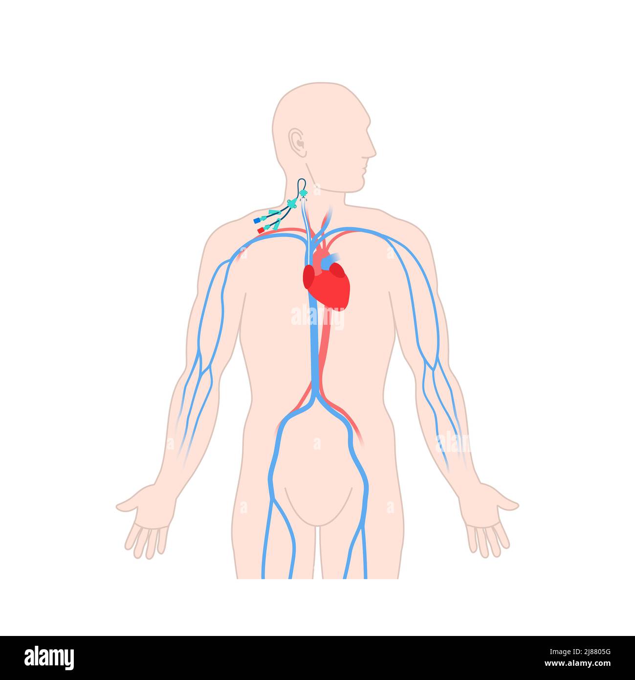 central venous catheter