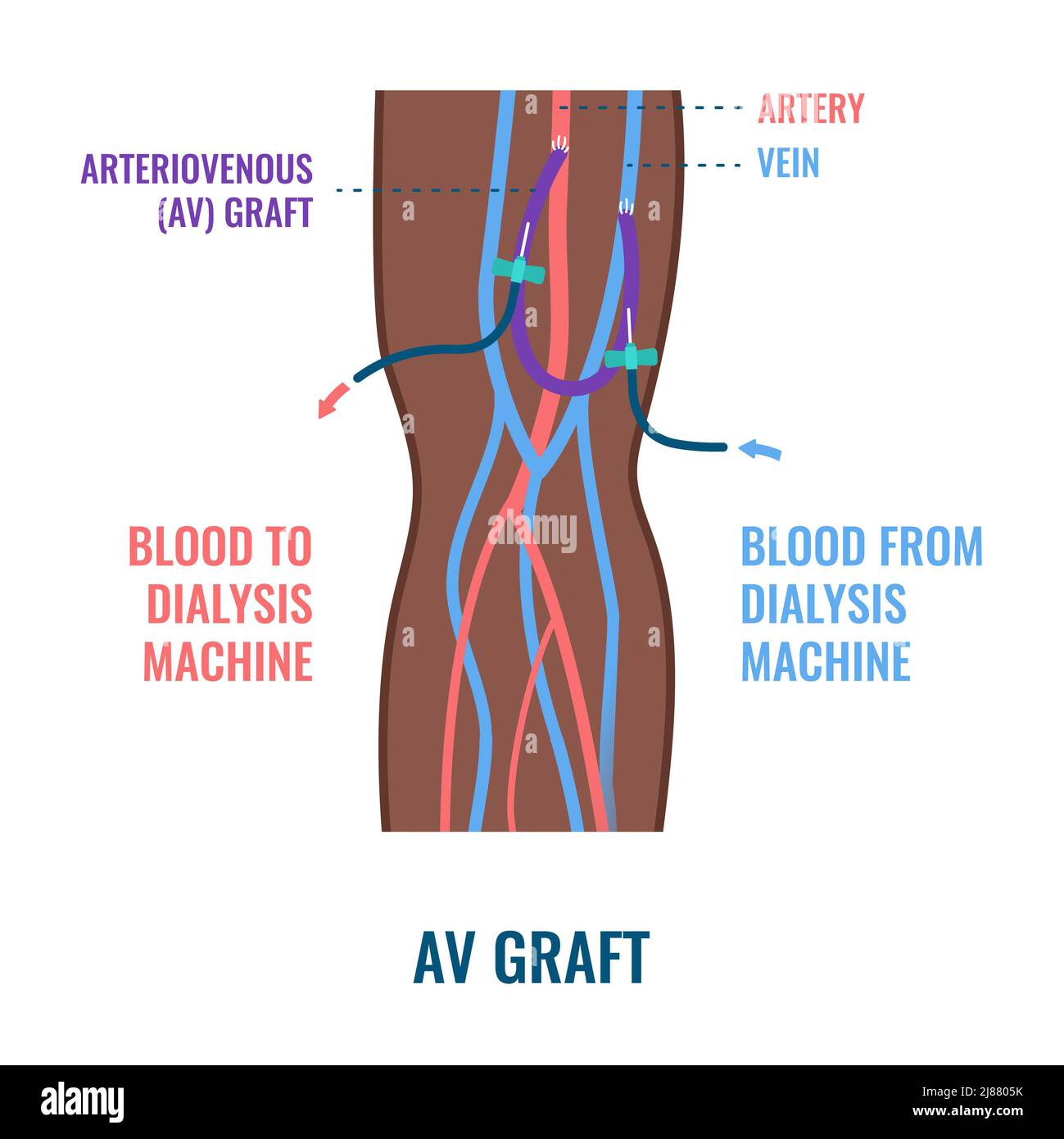 Dialysis shunt graft catheter, illustration Stock Photo Alamy