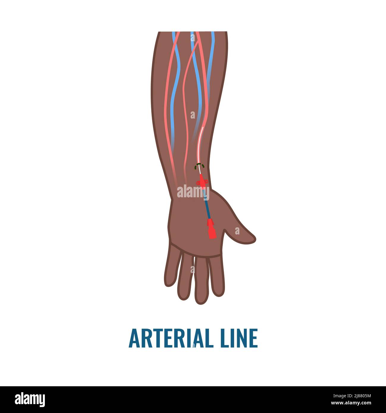Arterial line catheter, illustration Stock Photo Alamy