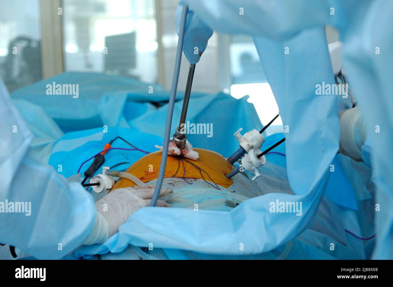 Laparoscopy surgery. Surgeon hand holding laparoscopic instrument attached to a patient belly Stock Photo