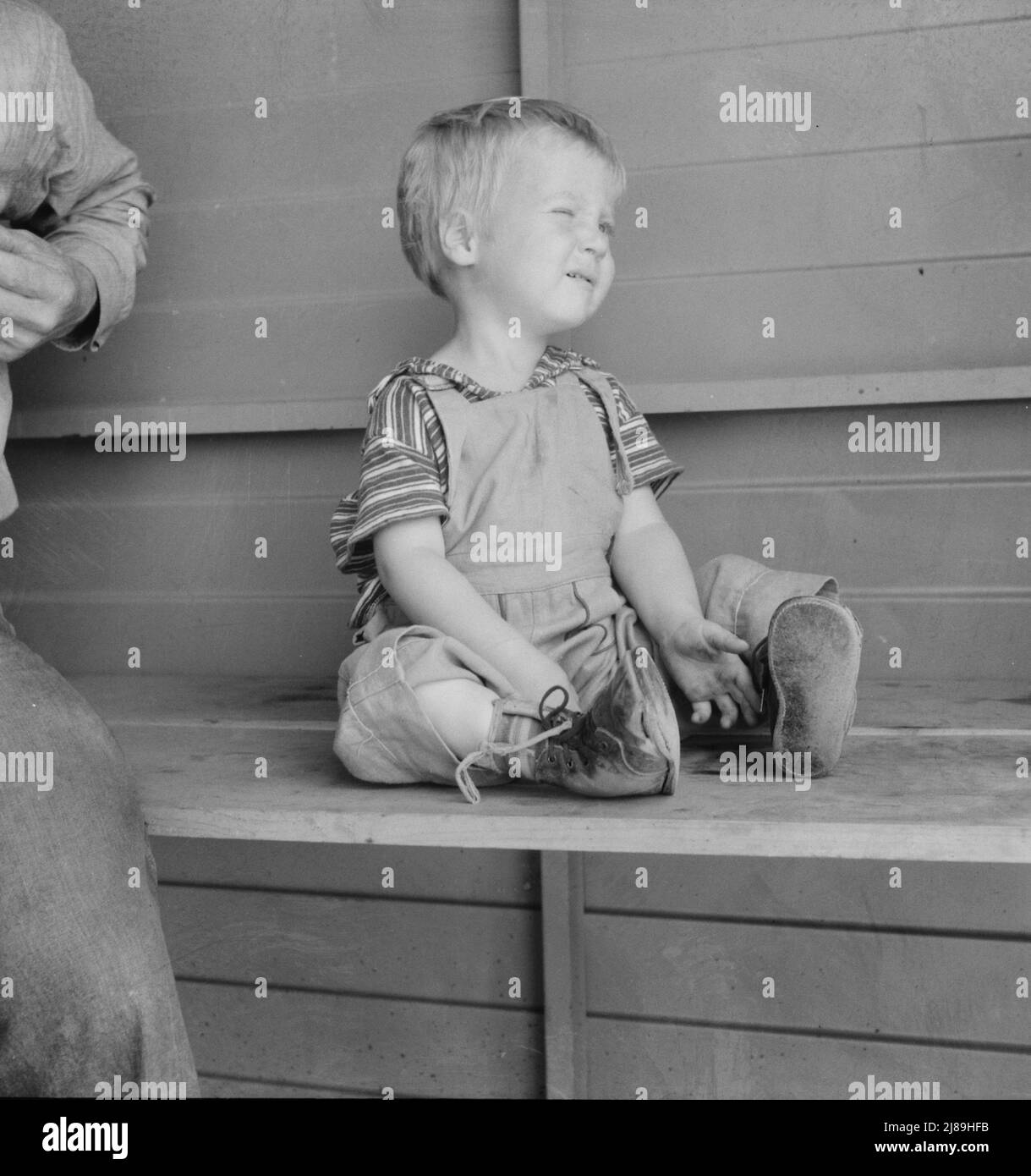 Tulare County, California. In Farm Security Administration (FSA) camp for migratory workers. Baby with club feet wearing homemade splints inside shoes. Stock Photo