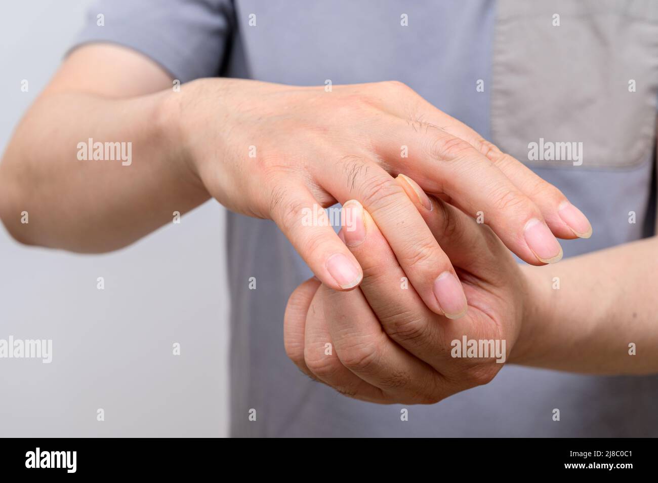 Rheumatoid arthritis hands hires stock photography and images Alamy
