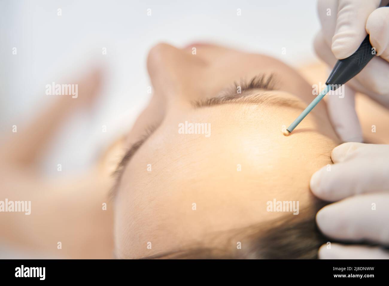 Woman receiving mole removal skincare treatment in clinic Stock Photo
