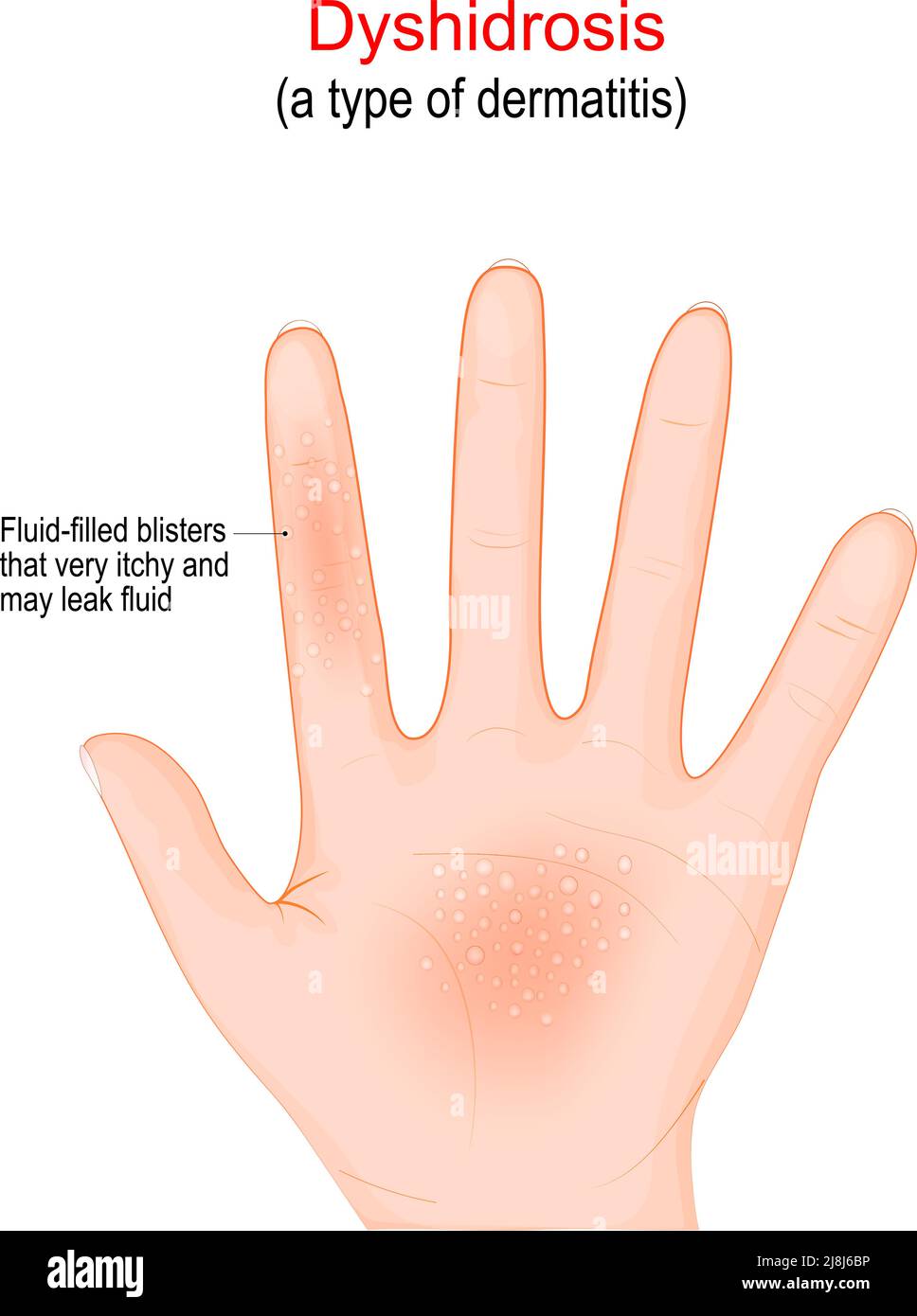 Dyshidrosis. type of dermatitis with itchy blisters on the palms of the hands. Fluid-filled blisters very itchy. Vector illustration Stock Vector