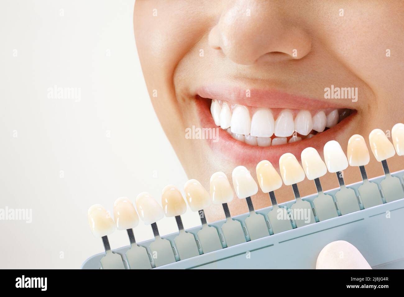 Smiling young woman. Cosmetological teeth whitening in a dental clinic. selection of the tone of the implant tooth Stock Photo