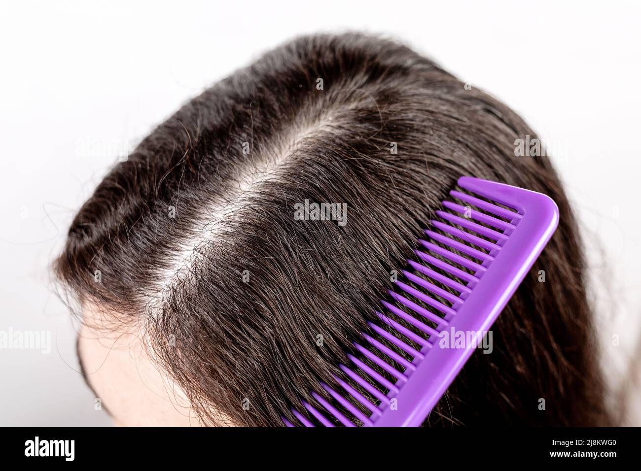 Scalp Psoriasis And Hair Loss What Is The Connection?, 50 OFF