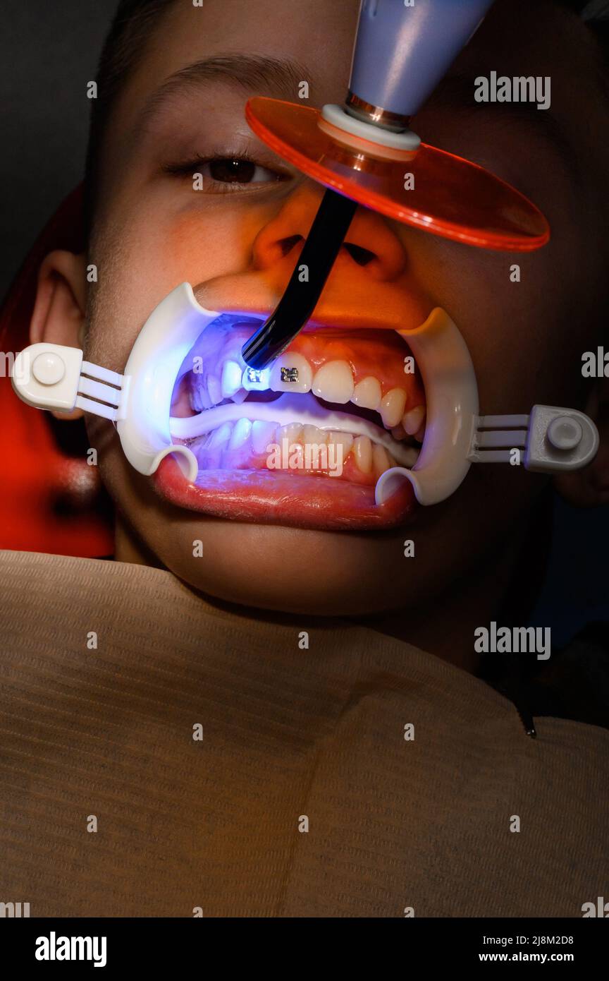 Alignment of crooked teeth with the help of braces, installation of