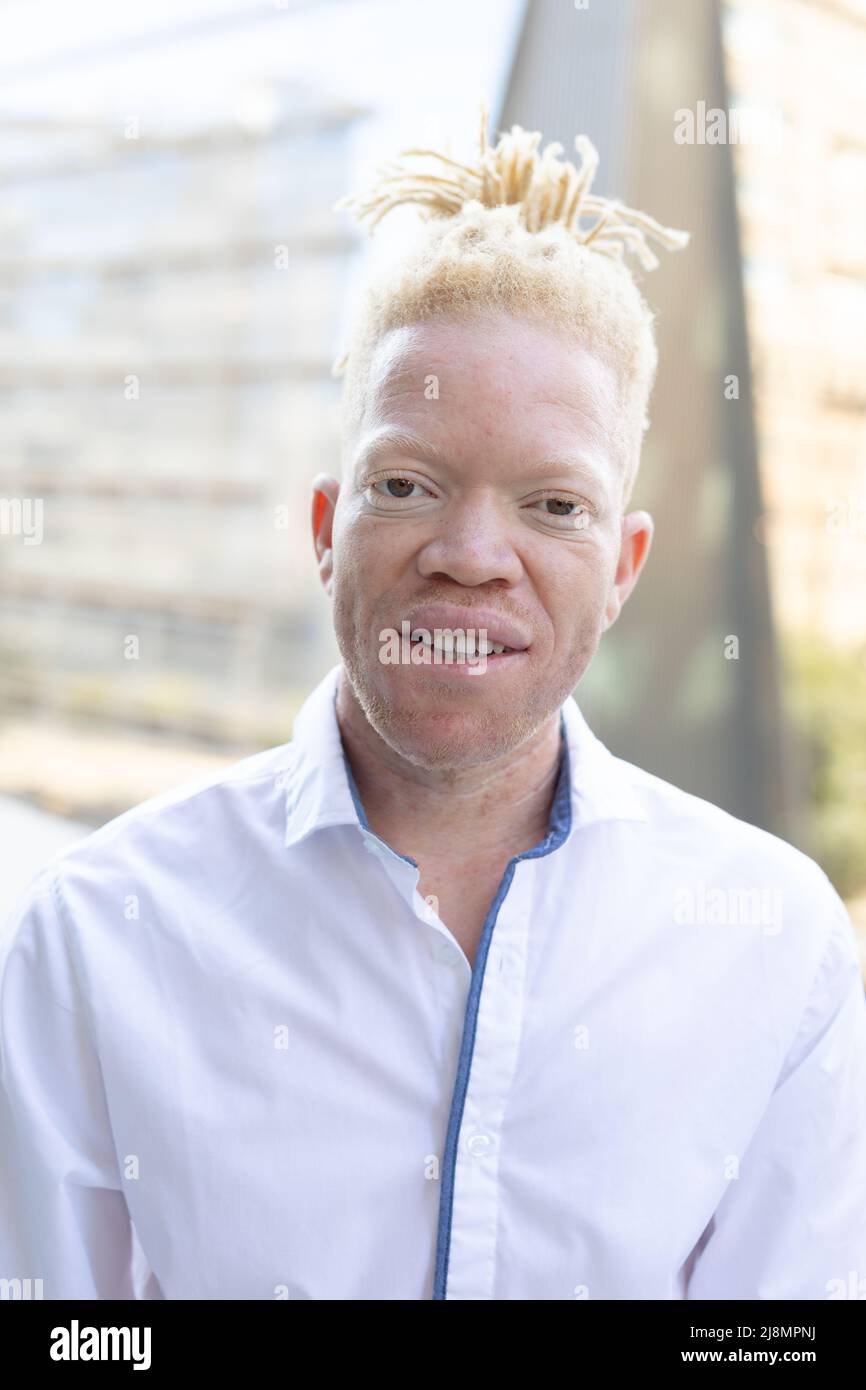 albino african american model